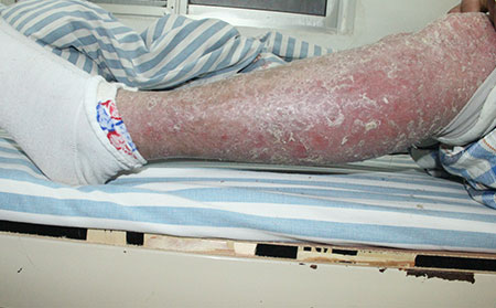 治療銀屑病的正規(guī)醫(yī)院