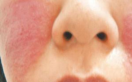 牛皮癬患者的飲食問題