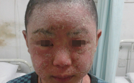 預(yù)防頭部銀屑病遷延加重的方法