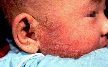 兒童面部銀屑病