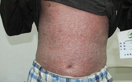 全身牛皮癬如何治療