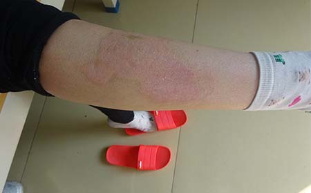 銀屑病治療費(fèi)用