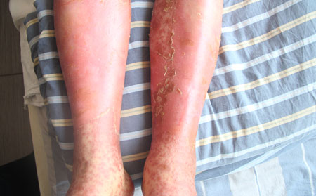 紅皮型銀屑病的癥狀