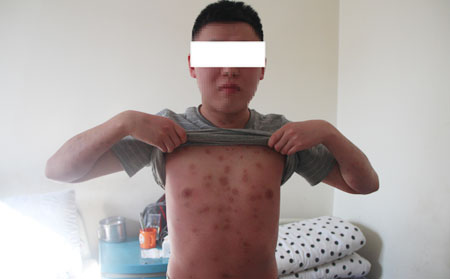 紅皮型銀屑病的危害