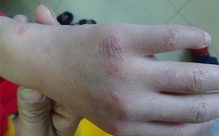 牛皮癬治療