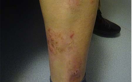 銀屑病早期的癥狀