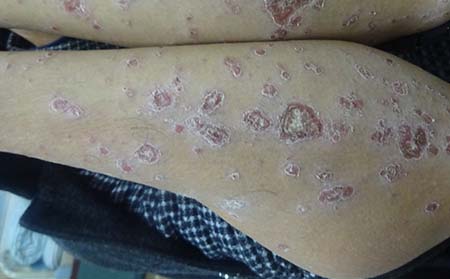 塊狀牛皮癬復(fù)發(fā)