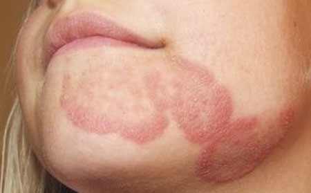 銀屑病紅斑融合