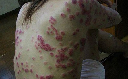 別人治療銀屑病容易