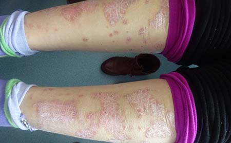 治牛皮癬復發怎么辦