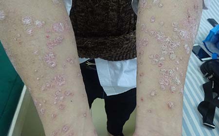 濰坊治療銀屑病的可以方法