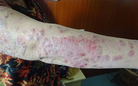 銀屑病常識知識