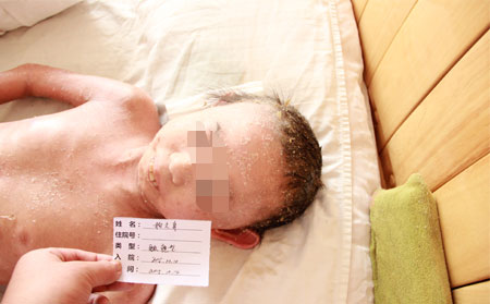 牛皮癬的發病原因