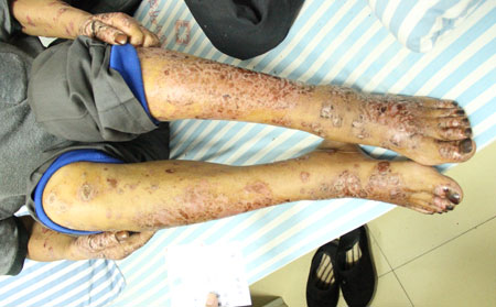 牛皮癬的治療方式