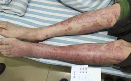 治療牛皮癬那種方法可以