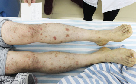 牛皮癬怎么治見到效果快