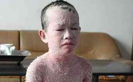 少年牛皮癬怎么預(yù)防