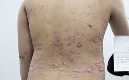 銀屑病在冬天怎么護(hù)理