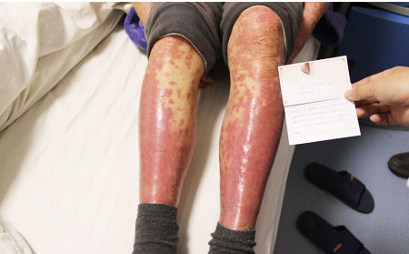 銀屑病該怎么護理