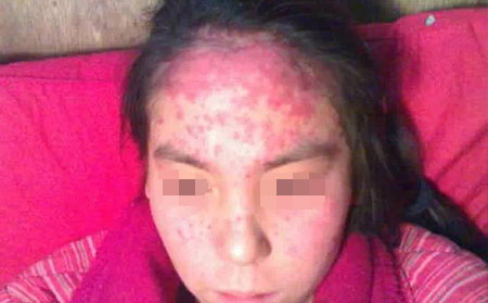 牛皮癬形成的原因