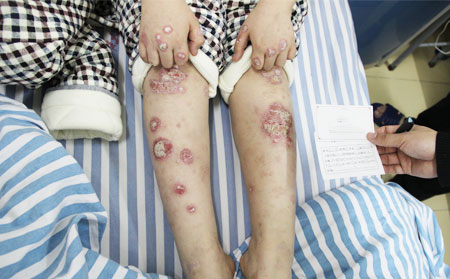 銀屑病怎么治療