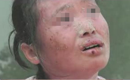 怎么防治牛皮癬擴(kuò)散