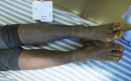 牛皮癬會對人體造成什么危害