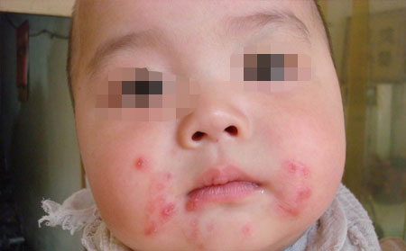 牛皮癬有什么原因