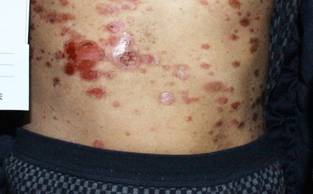 銀屑病的發病原因