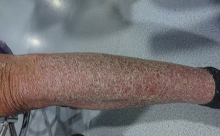 中醫治療銀屑病