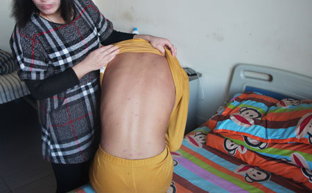 患上牛皮癬奇癢怎么辦  有什么可以止癢的方法