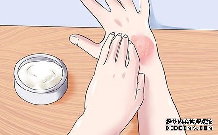 銀屑病有什么癥狀