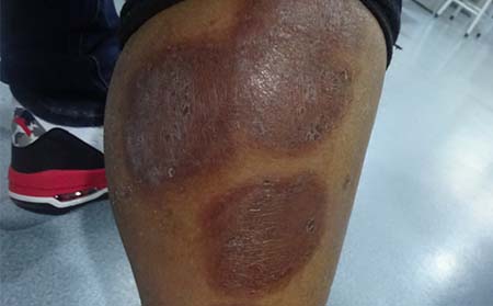 銀屑病應該怎么治療