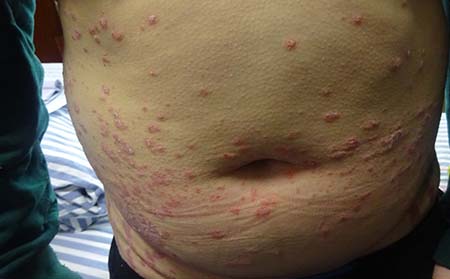 銀屑病應(yīng)該怎么進(jìn)行護(hù)理