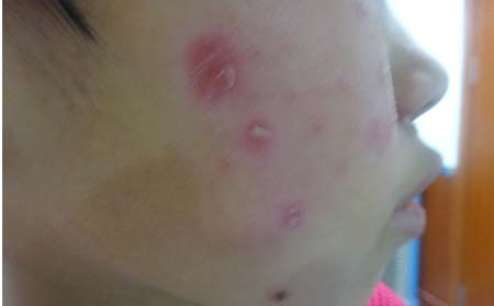 銀屑病應(yīng)該怎么預(yù)防