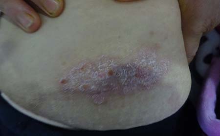 鍛煉出汗恢復銀屑病 希望大家看看多加了解