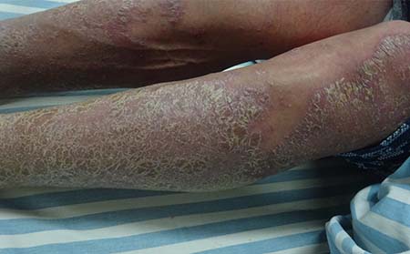 關節型銀屑病的疼痛如何緩解