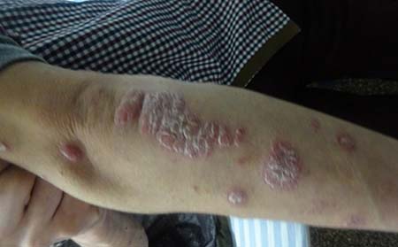 尋常性銀屑病何時可以轉