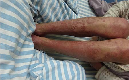 老人銀屑病的原因