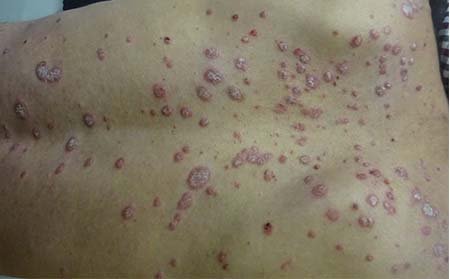 牛皮癬復發和飲食有什么關系嗎