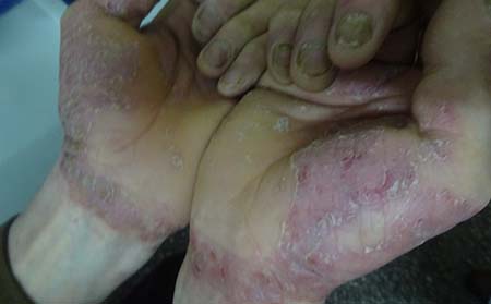 女性牛皮癬患者在懷孕期間要注意哪些問題呢