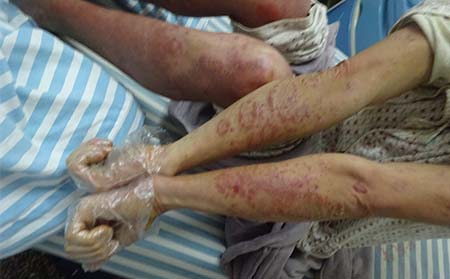 急性進行期的銀屑病要如何護理呢