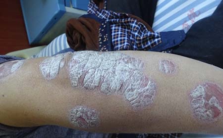 使用化妝品會使銀屑病病情加重嗎