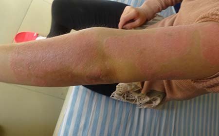 適合銀屑病患者養生的方法有哪些