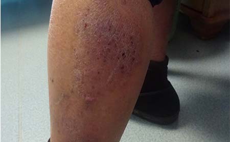 多運動更有助于銀屑病的治好