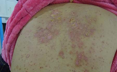 紅皮型銀屑病的危害是什么?