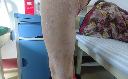 女性銀屑病患者治療期間盡量不要化妝