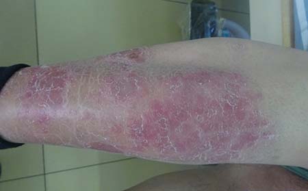 尋常型牛皮癬有哪些危害