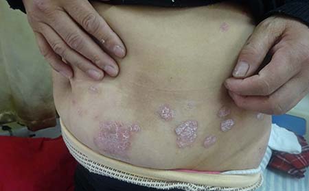 怎樣預防關節型銀屑病復發