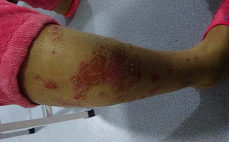 小暑節氣銀屑病患者如何正確使用風扇降溫